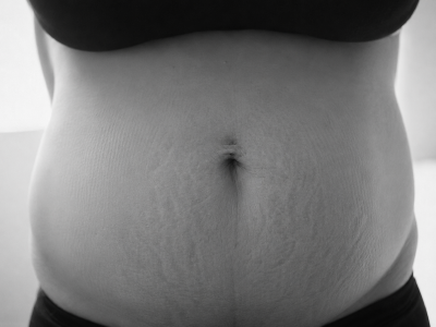 Abdomen de madre postparto
